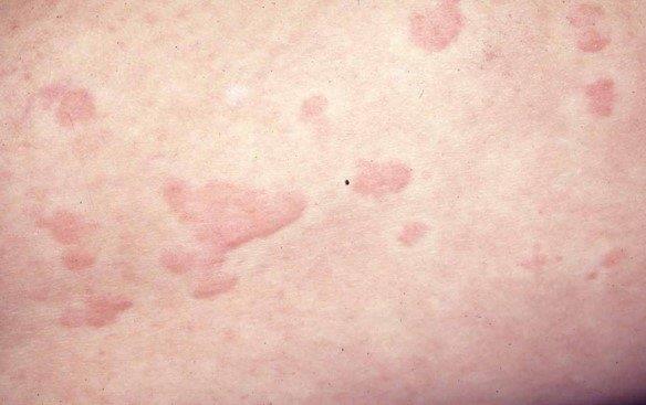 Chronic Urticaria(慢性蕁麻疹) - Presentation by Dr. Yeung Ho Hong(楊浩康)